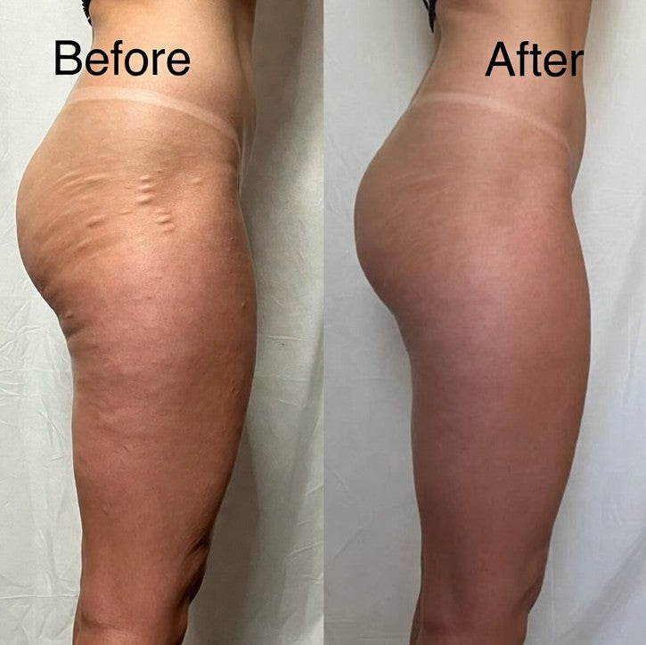 ANTI-CELLULITE CREAM