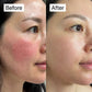 ROSACEA RELIEF CREAM