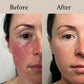ROSACEA RELIEF CREAM