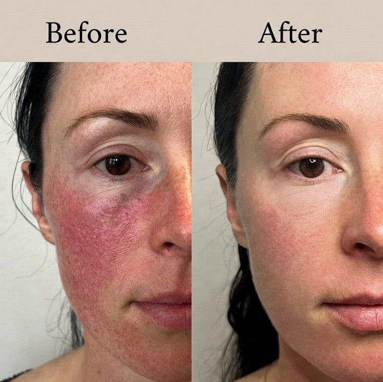ROSACEA RELIEF CREAM