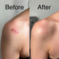 SCAR GEL