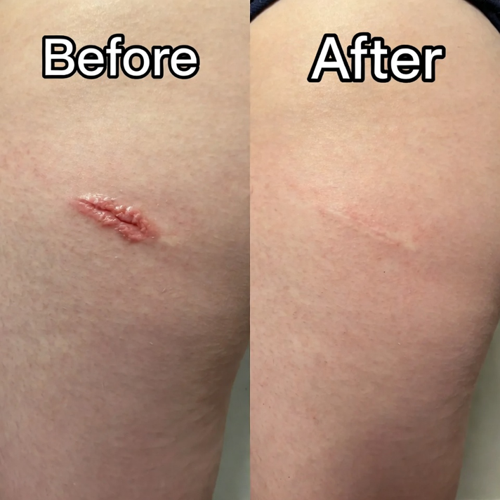 SCAR GEL