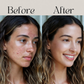 ANTI-ACNE CREAM